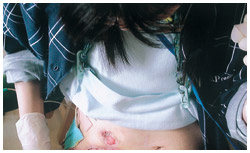 写真：ストーマ周辺の皮膚に広がる潰瘍化していく炎症