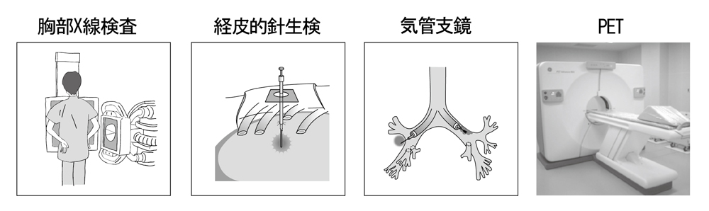 ※最近ではCTで見つかるような2cm以下の小さい肺の影の場合には確定診断と治療を兼ねて最初から手術を行うことがある。