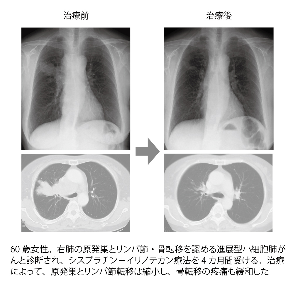 図6 進展型小細胞肺がんの患者さん事例