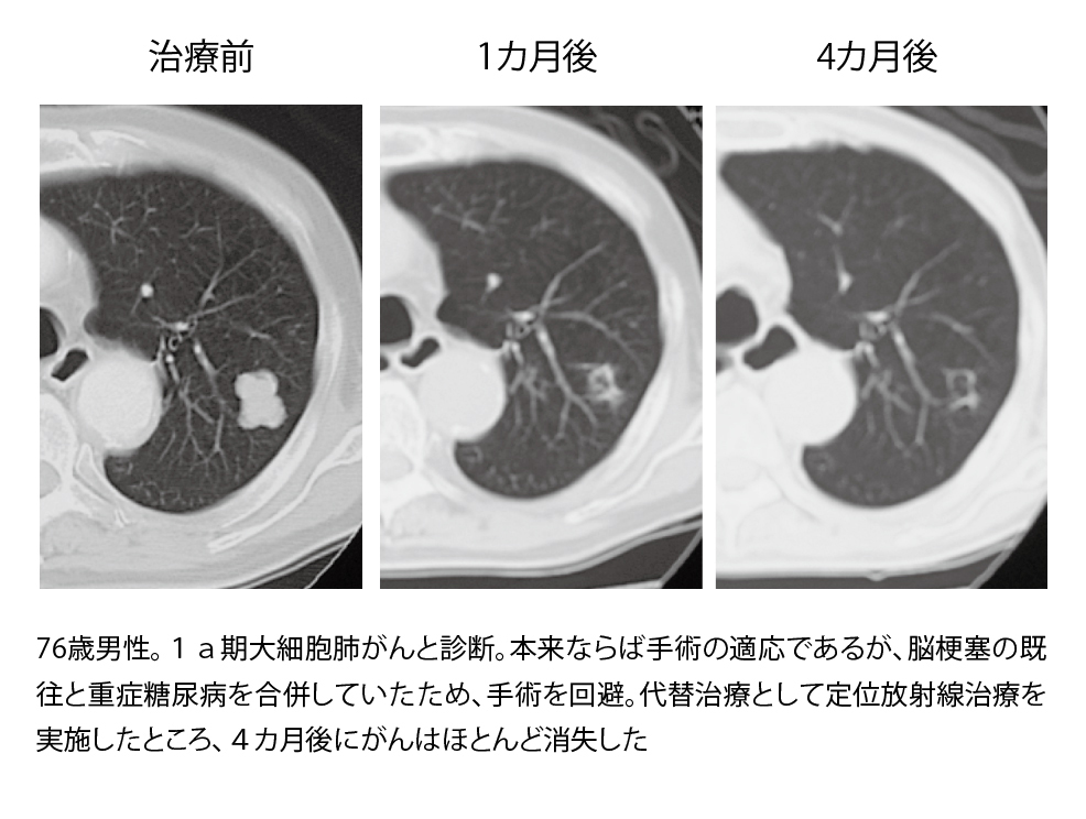 ■図6 高齢患者さんの治療例