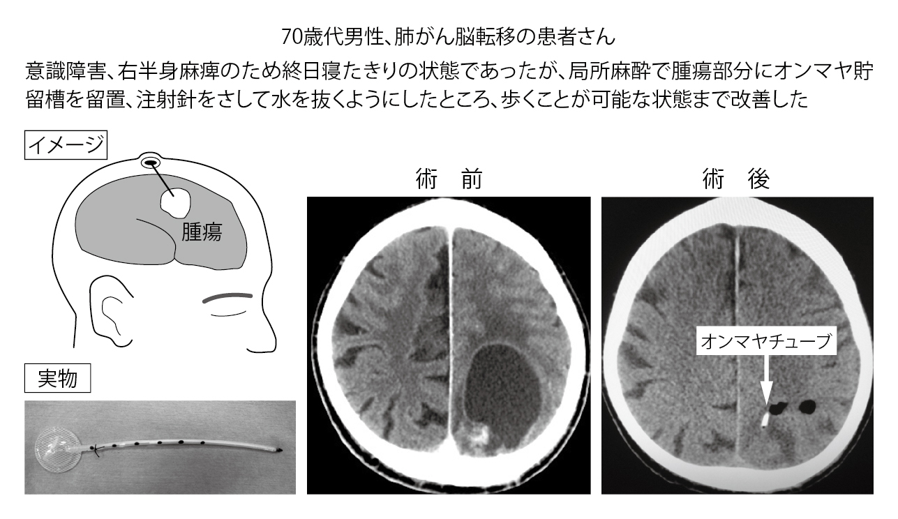 ■症例6 嚢胞性タイプの脳転移に対するオンマヤ貯留槽留置術 ■症例6 嚢胞性タイプの脳転移に対するオンマヤ貯留槽留置術