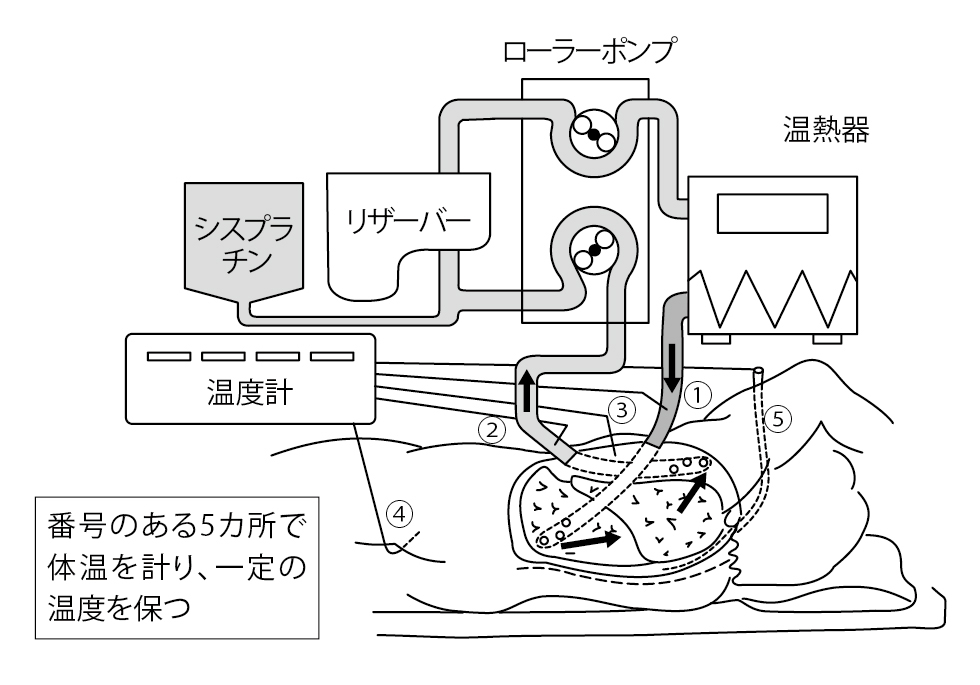 ■図6 胸腔内温熱化学濯流療法のシステム ■図6 胸腔内温熱化学濯流療法のシステム