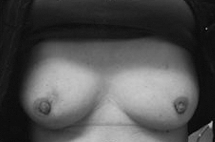 ■写真5 KORTUCⅡで乳房温存を行った症例 ■写真5 KORTUCⅡで乳房温存を行った症例