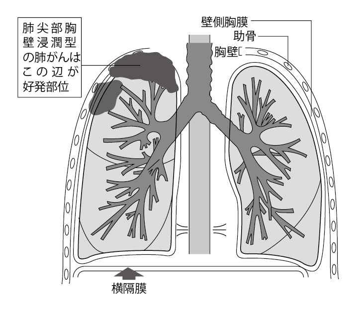 ■図2 肺尖部胸壁浸潤がんについて