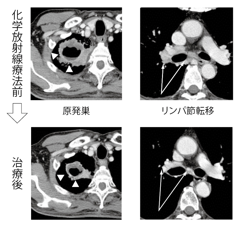 ■画像3【症例1】61歳男性　右肺上葉 非小細胞肺がん　3A期(TNM分類ではcT3N2M0)　