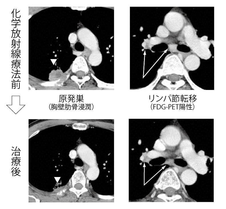 ■画像4【症例2】55歳男性　右肺上葉 扁平上皮がん　3A期(TNM分類ではcT3N2M0)