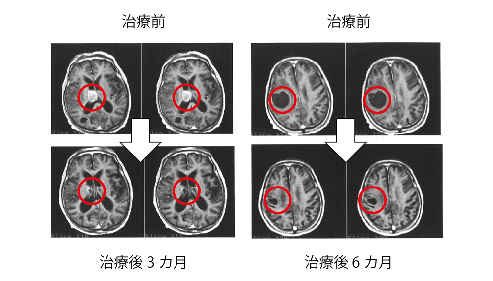 ■画像3 サイバーナイフの脳腫瘍における治療効果