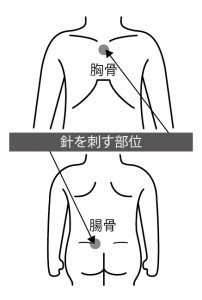 ■図5 骨髄検査について ■図5 骨髄検査について