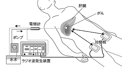 図6 ラジオ波焼灼療法