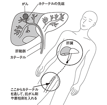 図7 肝動脈化学塞栓術