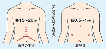 開腹手術と腹腔鏡の傷の違い