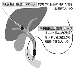 図4 胆道ドレナージ