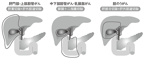 図5 部位別にみた代表的な術式における切除範囲