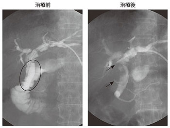 写真5 ゲムシタビンとTS-1併用術前化学療法の効果