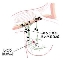 図：脇の下のリンパ節とセンチネルリンパ節