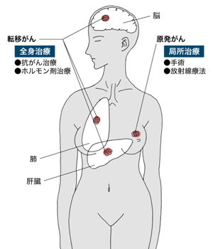 イラスト：局所治療と全身治療