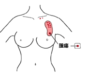 イラスト：乳房円状部分切除術