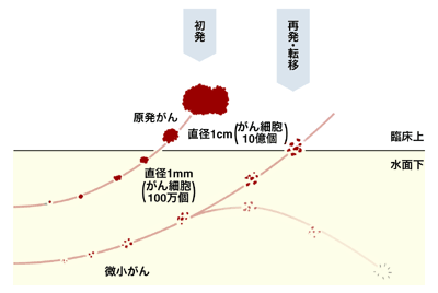 図:乳がんにおける再発の様子