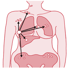 図：乳がんの転移