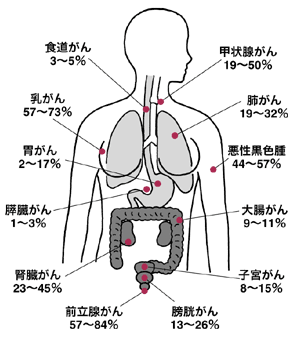 図：骨転移が起こるがん