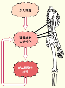 図：骨転移で骨が破壊されるメカニズム