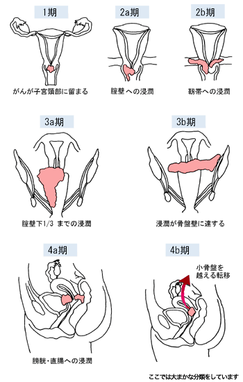 子宮頸がんのステージ（病期）分類