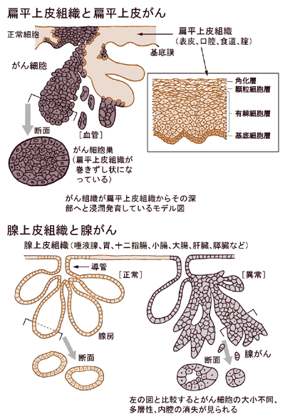 扁平上皮がんと腺がん