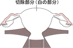 単純子宮全摘出術
