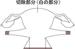 広汎子宮全摘出術