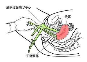図1　子宮頸部の細胞採取