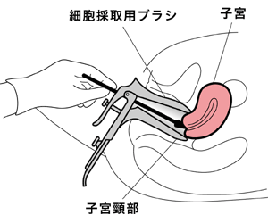 図:子宮頸部細胞診の方法