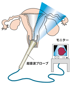 図:経腟超音波検査の方法