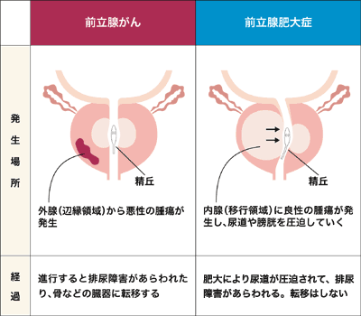 図：前立腺肥大症と前立腺がん