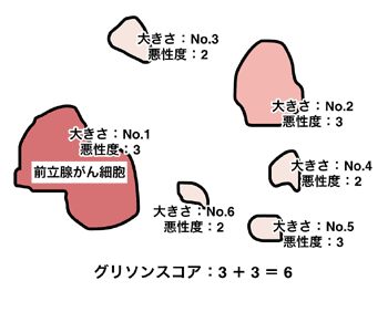 図：グリソンスコアの計算方法