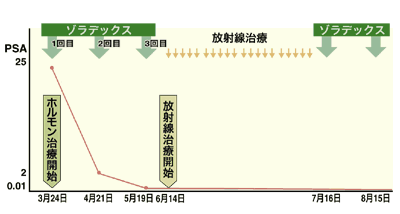 図：ホルモン療法＋放射線併用療法の治療スケジュール