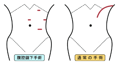 図：腎臓がんの腹腔鏡下手術と通常の手術の違い
