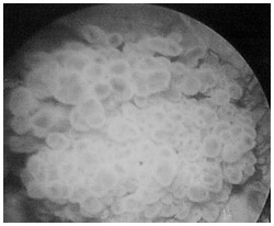 写真：内視鏡で見た膀胱がん