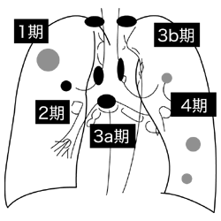 図：肺がんの進行度