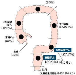 大腸がんのできやすい場所イラスト