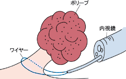 内視鏡的ポリペクトミー