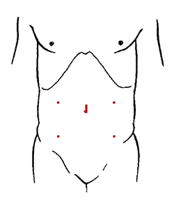 腹腔鏡手術創