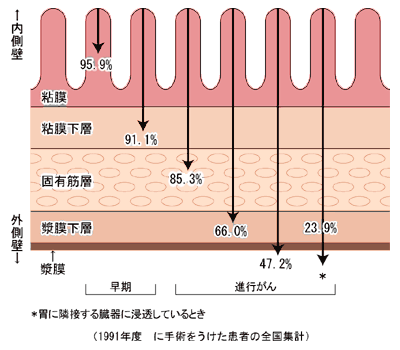 がんの深達度と5年生存率の関係