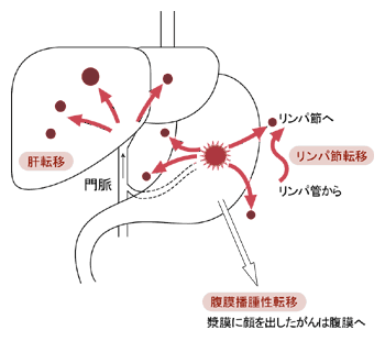 胃がんの転移