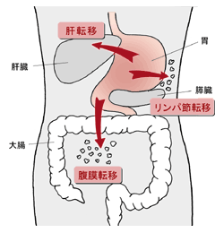 胃がんの転移様式