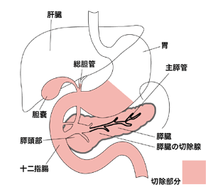 図：膵頭十二指腸切除術