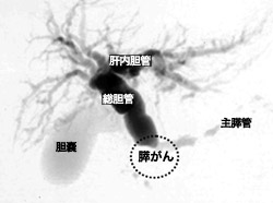 写真：MRCP画像