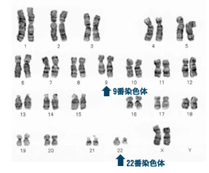 人間の染色体（フィラデルフィア染色体）