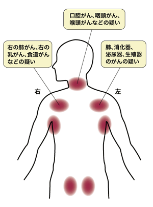 図：リンパ節の腫れと原発巣との関係