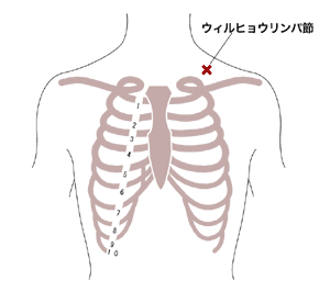 図:ウィルヒョウリンパ節