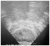 超音波検査で見た前立腺がん